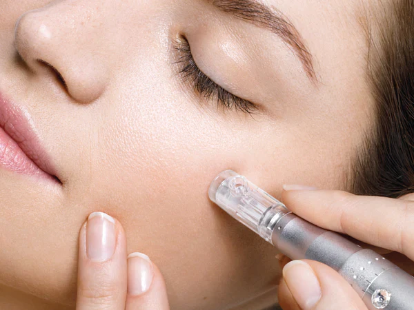 Professional microneedling treatment at Alicia Beauty in Tooting